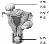 专家详解子宫肌瘤对广州助孕的影响