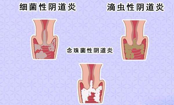 阴道炎