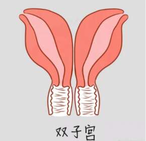 双角子宫能做试管婴儿吗？