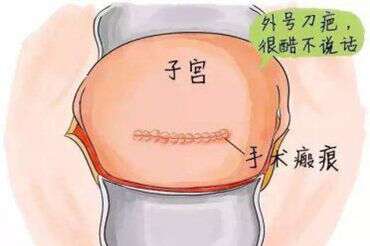 疤痕子宫做试管，风险多大？