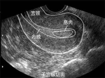 试管时遇到“子宫内膜息肉”该怎么办？