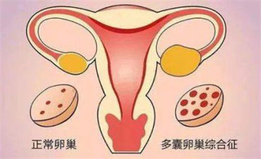 卵巢囊肿会影响试管的进度吗？