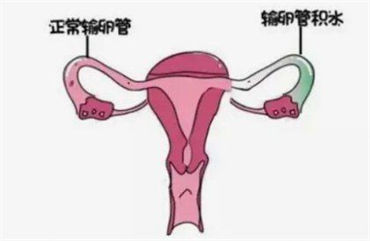 输卵管产生积水需要选择试管来帮助怀孕？