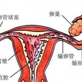 输卵管不同程度的堵塞都可以做试管婴儿吗？