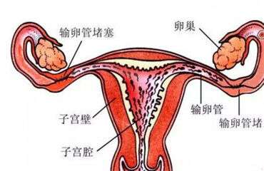 输卵管不育该怎么做广州助孕呢？