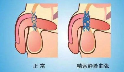 试管检查前发现精子质量低？可能是精索静脉曲