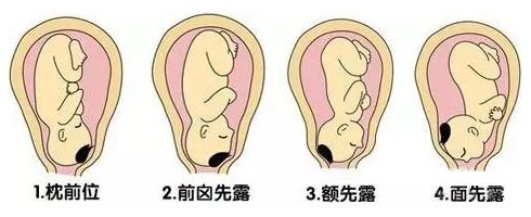 孕32周胎位不正的纠正方法