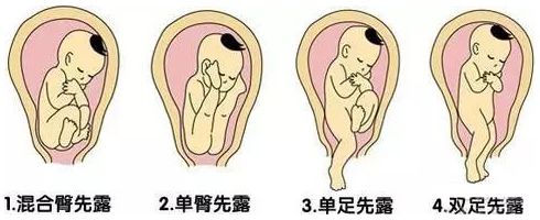 孕32周胎位不正的纠正方法