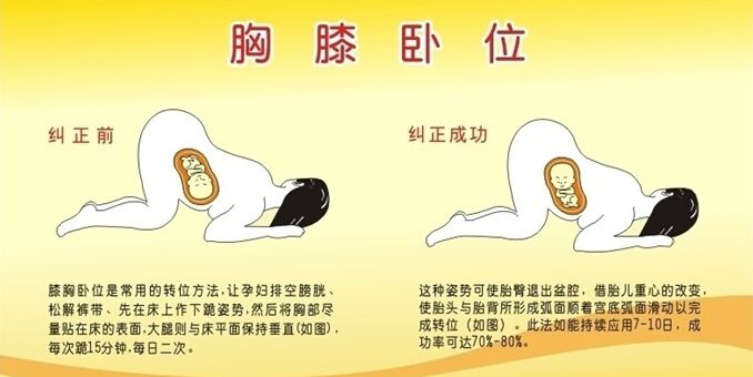 孕32周胎位不正的纠正方法