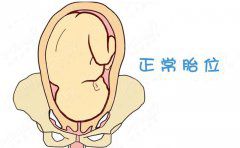 孕32周胎位不正的纠正方法