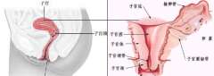 为什么会发生宫腔粘连