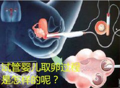 试管婴儿取卵过程是怎样的呢？
