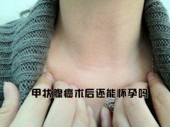甲状腺癌术后还能怀孕吗？