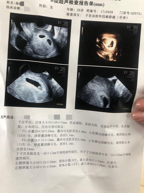 胚胎级别高≠胚胎质量好