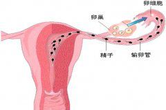 取卵后出现腹胀腹水怎么办？
