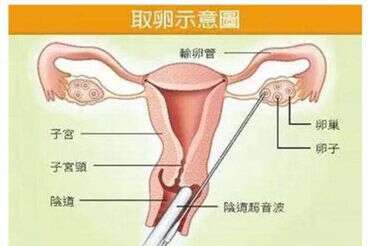 卵巢早衰的原因，你了解几个