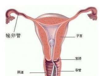 输卵管堵塞能做广州助孕试管婴儿吗？