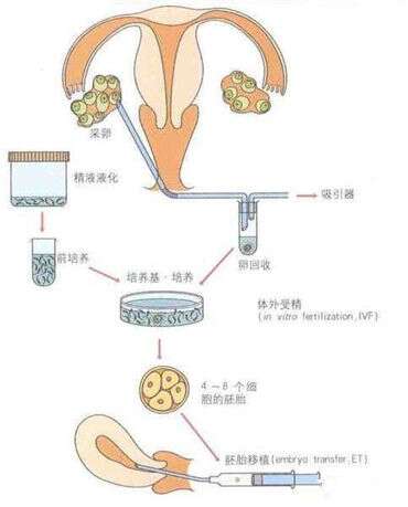 90%广州代妈会产生妊娠线