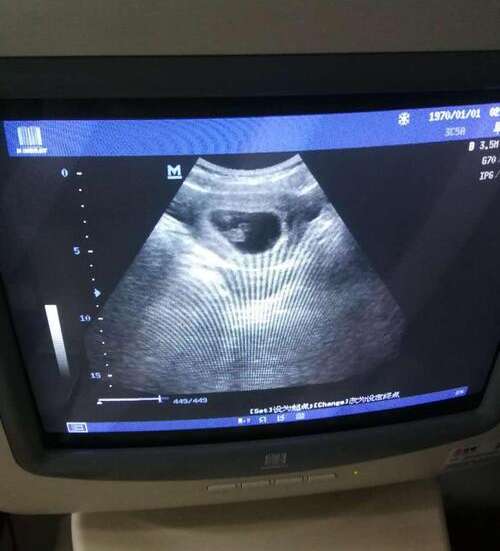 日常生活中如何保护卵巢