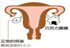 巧克力囊肿合并不孕症，该如何处理