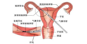 做试管婴儿前需做哪些检查