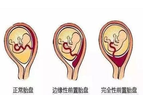 广州第三代试管对子宫条件有什么要求吗?