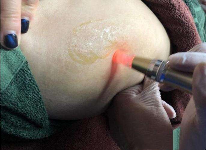 什么可以预防乳腺囊肿的发生