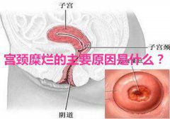 宫颈糜烂的主要病因是什么？