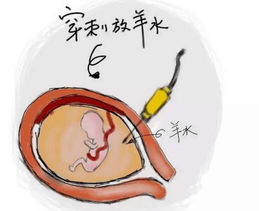 广州代妈羊水过多如何护理？