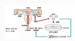 广州第二代试管婴儿（ICSI）