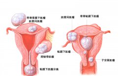 什么是子宫肌瘤