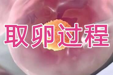 取卵过程