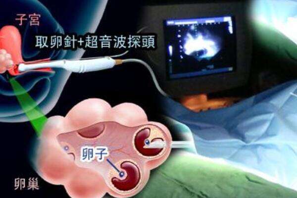 取卵过程