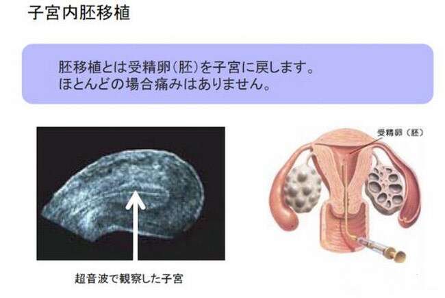 微刺激方案是什么