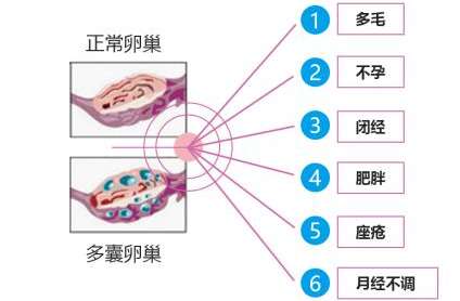 多囊卵巢综合症/多囊卵巢综合征