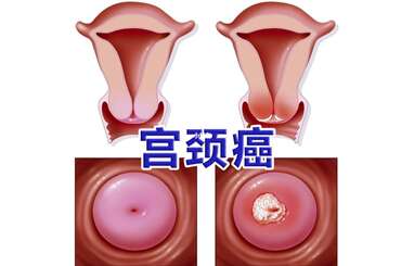 宫颈癌