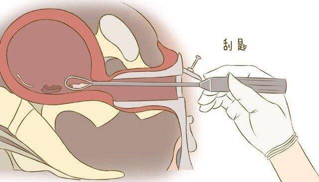 刮宫术