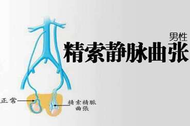 精索静脉曲张