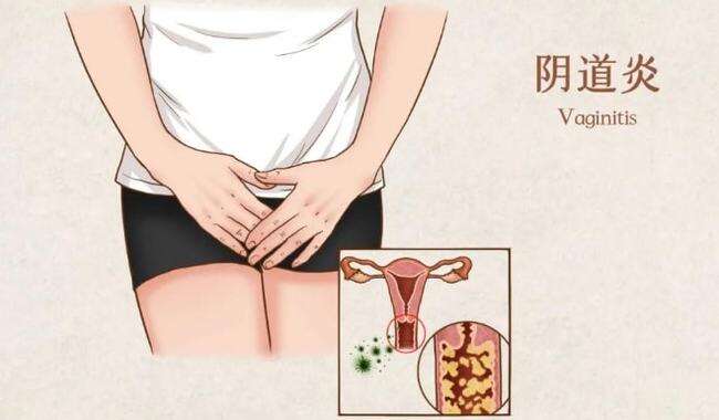 阴道炎
