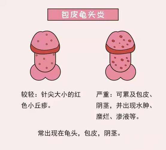 龟头炎
