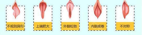 外阴性不孕