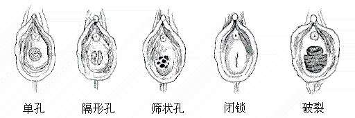 外阴性不孕