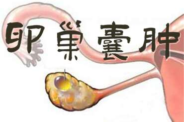 卵巢囊肿