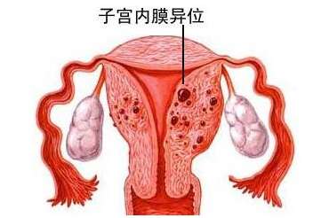 子宫内膜异位症