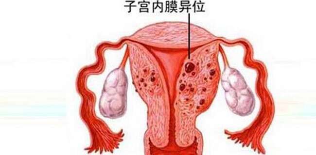 子宫内膜异位症