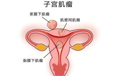 子宫肌瘤