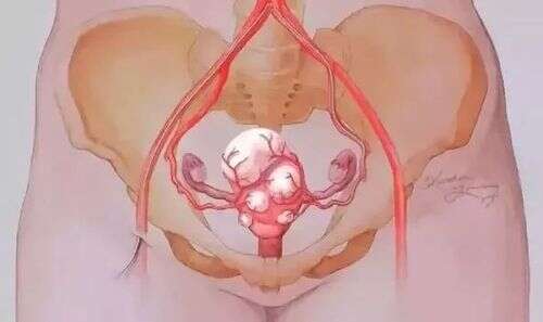 子宫肌瘤