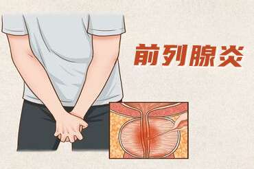 前列腺炎
