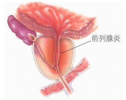 前列腺炎