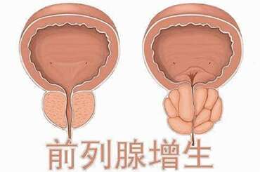 前列腺增生